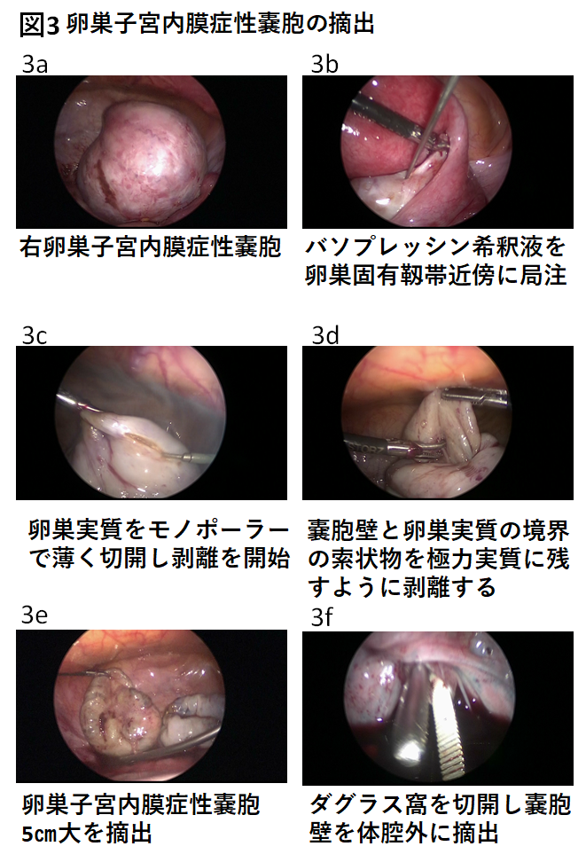 14 日帰り腹腔鏡下手術 日本産婦人科医会