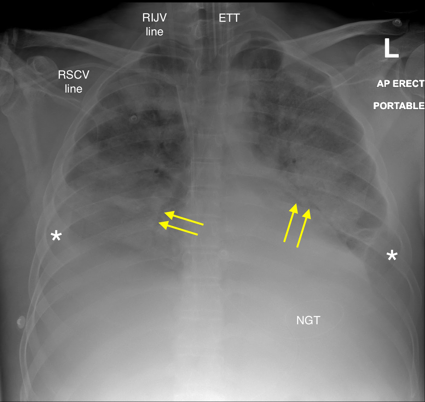 picture Ards Chest X Ray st vincent s university hospital radiology department