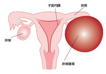 卵巣腫瘍 公益社団法人 日本産科婦人科学会
