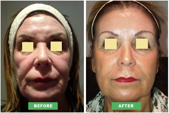 adult pimples food plan