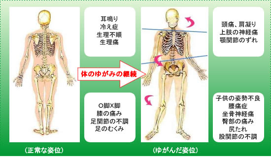 骨盤のゆがみ 仙腸関節症