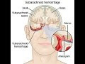 Subarachnoid Hemorrhage