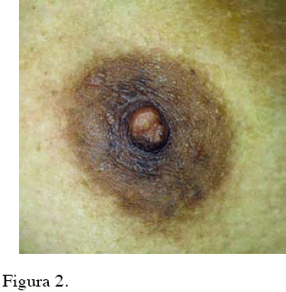 Infeccion Por Molusco Contagioso En Pezon A Proposito De Un Caso