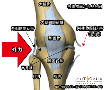 膝内側 外側側副靭帯損傷 スポーツ障害解説