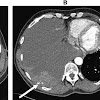Mesothelioma And Lung Cancer Differences - Hydrogen Peroxide Inhalation Method by Bill Munro : Each individual is unique, so survival rates, treatments and symptoms vary by pati.