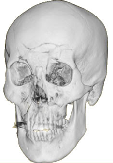 頭部外傷による高次脳機能障害とは ３ 福岡の弁護士による後遺障害 等級認定サポート