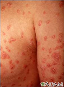 psoriasis