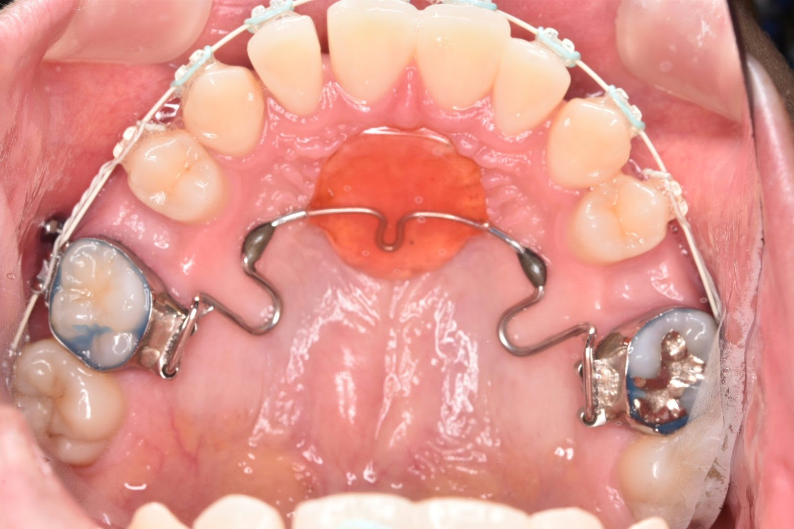 歯科衛生士wさんの矯正日記 南千住の矯正歯科 南千住小児歯科矯正歯科 土日診療 南千住の矯正歯科専門医院 南千住小児歯科矯正歯科