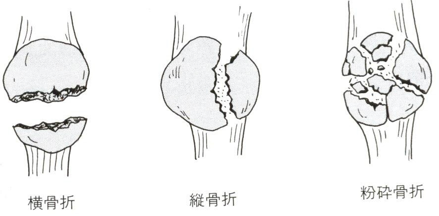 膝蓋骨骨折について 膝蓋骨ｆｘ 膝蓋骨ｆｘの多くは 直達外力によって発生します 膝蓋骨は膝の伸展機構を担っており 完全ｆｘでは膝の伸展が不可能になります しかし 不全骨折や腱膜下骨折では膝の伸展が可能な場合もあり 鑑別が必要です
