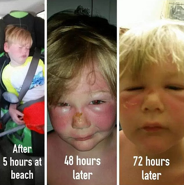 Should 2nd degree burns be covered - Minor burns may be successfully treated at home
