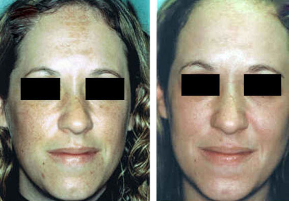 Fractional Erbium Yag Laser Mini Peel