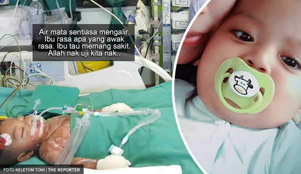 Badan bayi melecur 50% terkena air rebusan ketupat