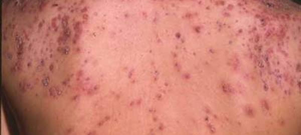 10 Best Body Washes Ϝor Back Acne 2019