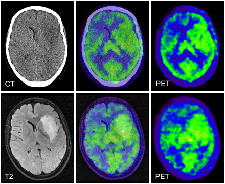 Hybrid PET/MRI of Intracranial Masses: Initial Experiences and
