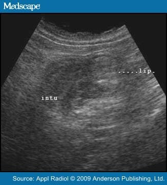 Colocolic Intussusception with Lipoma as the Leading Point