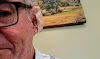 Prostate Cancer Surgery Images : Information about Skin Moles | Skin Surgery Laser Clinic - Learn about surgery options here.