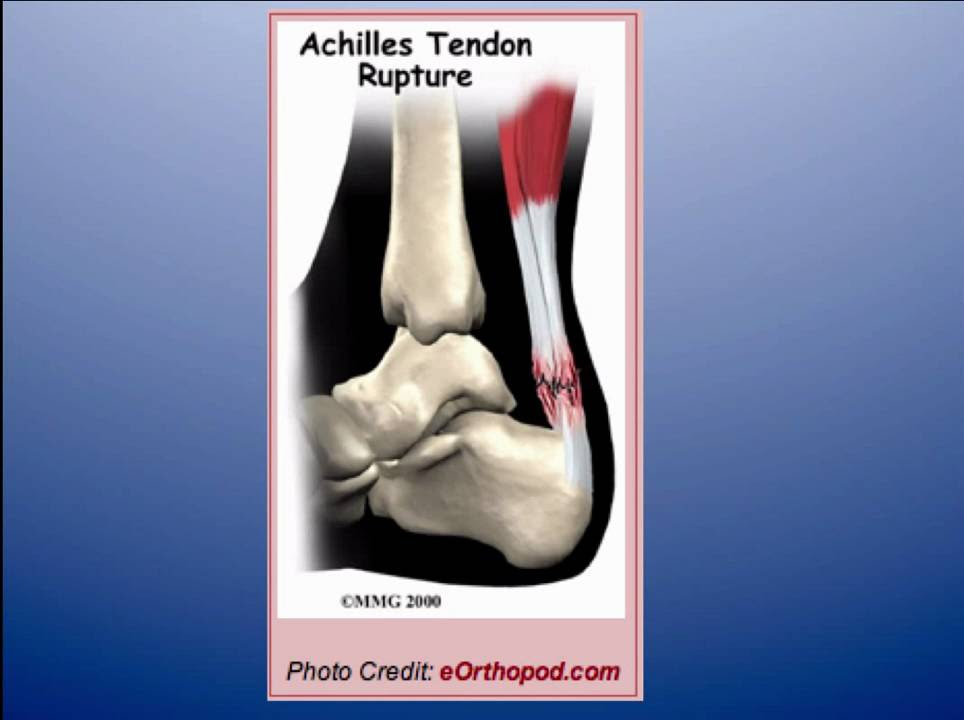 Achilles tendon rupture pain
