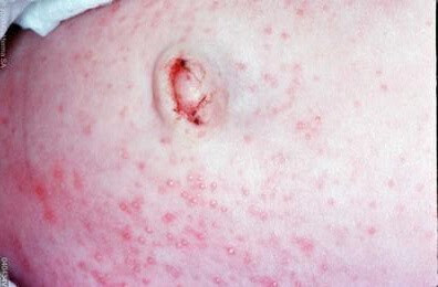 Erythema toxicum neonatorum - Huidarts.com