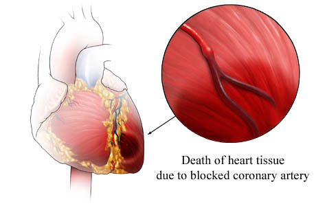 A heart attack is a medical