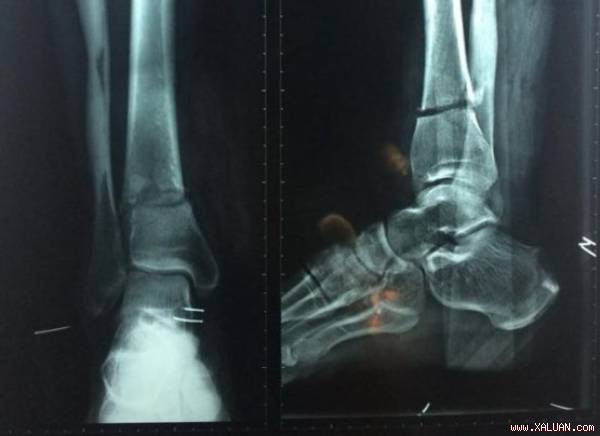 Máy cắt cỏ chém gần đứt lìa chân người đàn ông