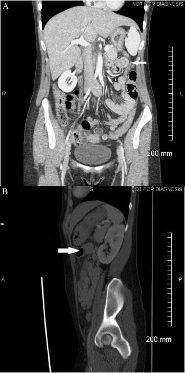 Target Sign Intussusception Ct / Whereas the diagnosis is usually already.