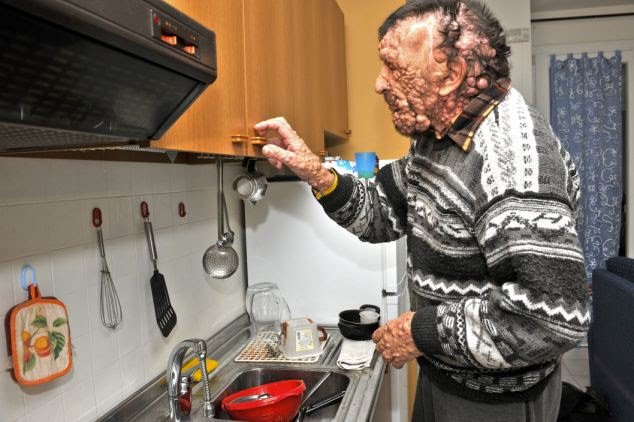 Mr Riva is covered from head-to-toe by the growths, a symptom of his genetic disease, neorofibramatosis