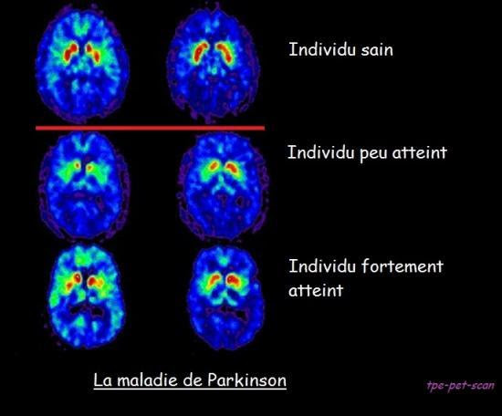 cancer du poumon métastases osseuses