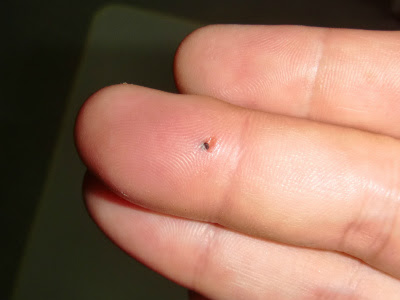 とげ が 刺さっ た 腫れ 指に刺さったトゲが抜けないときに知っておきたい抜き方５選