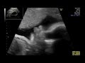 Les 80+ meilleures bébé à 7 mois de grossesse 105330