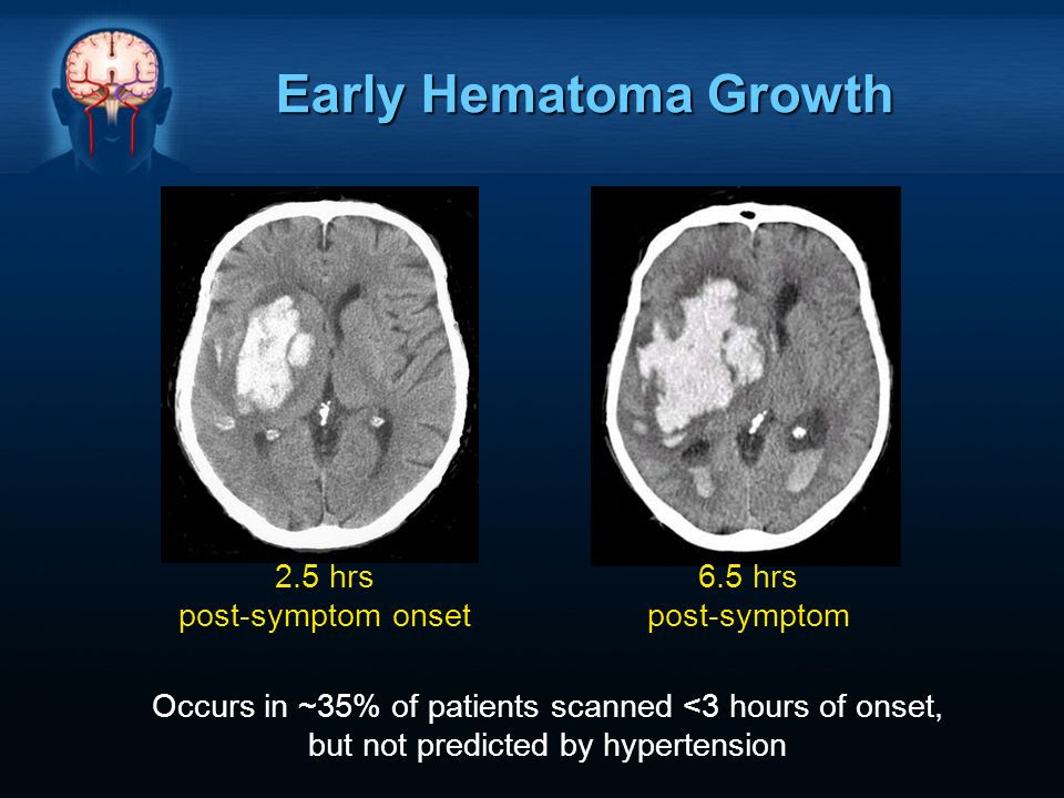 stroke symptoms after seizure