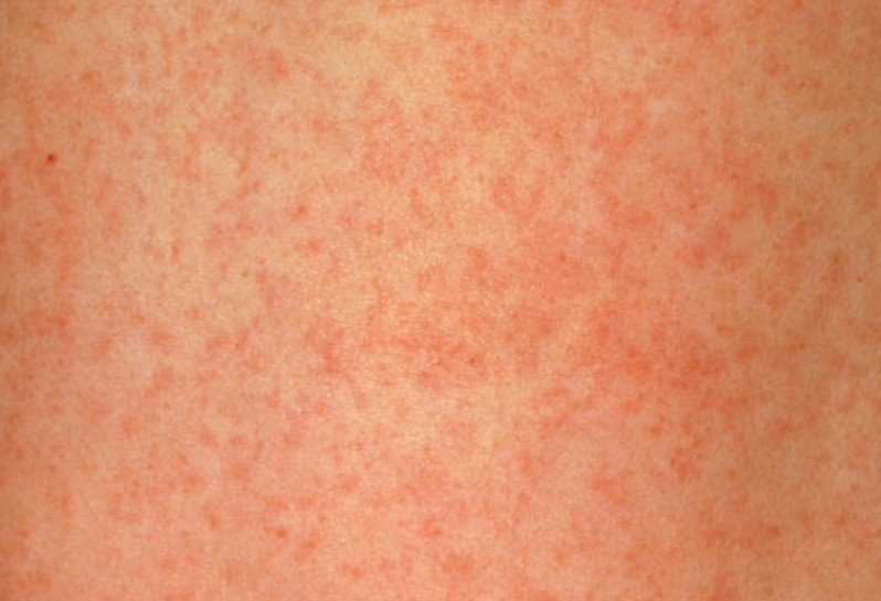 Measles (Rubeola) Symptoms and Signs: Causes