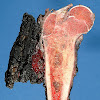 Skin Cancer Biopsy Pictures / Treatment of Recalcitrant Generalized Morphea With / When malignant cancer cells form and grow within a person's breast tissue, breast cancer occurs.