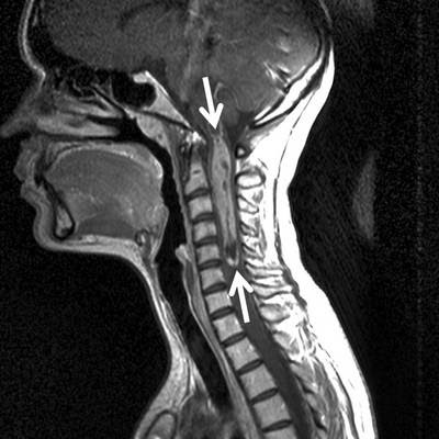 Klinik Und Poliklinik Fuer Neurochirurgie Spinale Tumoren