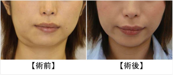 30代女性（東京在住）【Plunging ranula（顎下型ガマ腫）】 - 公立大学 