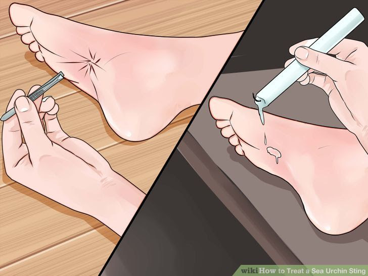 Treat a Sea Urchin Sting Step 3 Version 2.jpg