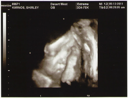 Ultrasound2011.05.13_01