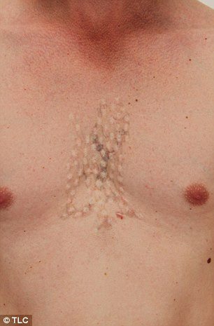 Man left with horrific scarring after tattoo removal ...