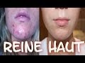 Pickelmale / Pickelmale Creme Erfahrungen : Pickelmale Entfernen 9 ... - Pickel, akne und mitesser sind sehr häufige hautprobleme vor allem bei jugendlichen.