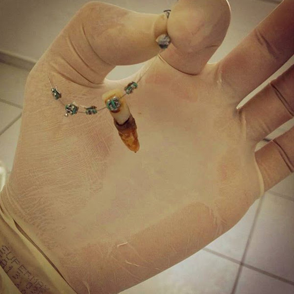 Aparelho e doença periodontal não combinam