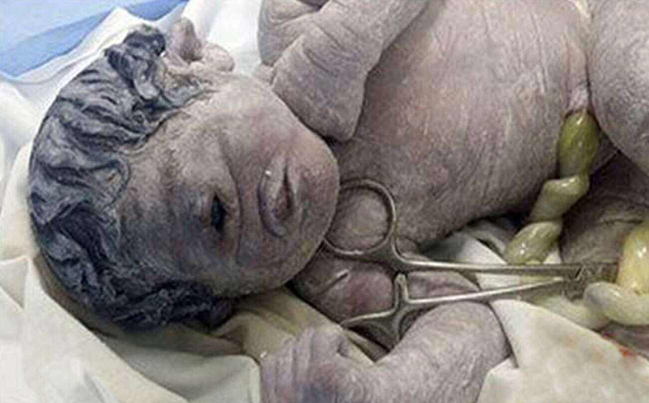 Bebê choca o mundo ao nascer com apenas um olho no meio da testa