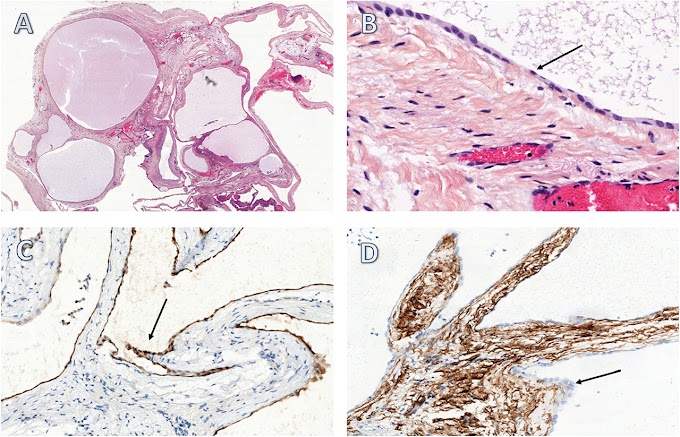 Mesothelium Histology : Webpathology Com A Collection Of Surgical Pathology Images / The fibrous pericardium is the outer layer, and the serous pericardium is the inner layer.the space between the two layers is the pericardial cavity.