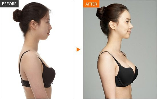 Tư vấn chuyên gia, bác sĩ về nâng ngực bao thì lành, mềm và hết đau