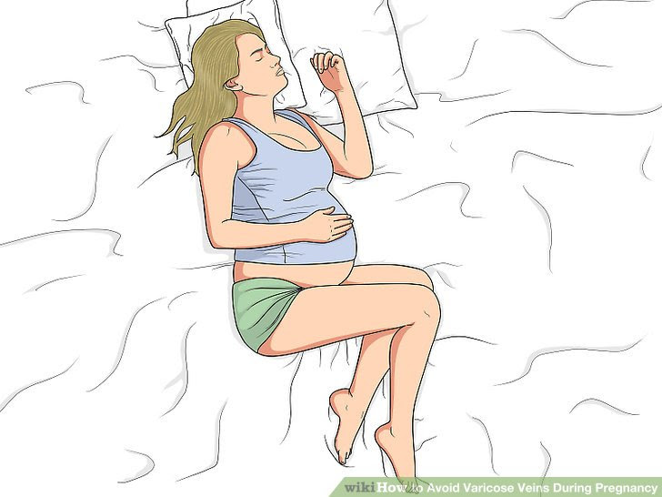 Avoid Varicose Veins During Pregnancy Step 7 Version 2.jpg