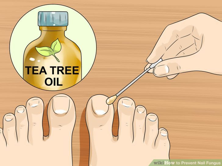 Cure Toenail Fungus with Vinegar Step 5.jpg
