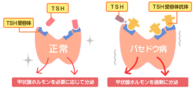 甲状腺の病気 バセドウ病について Harecoco Net