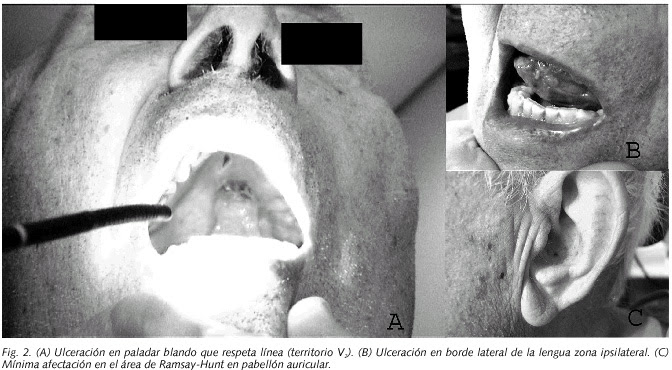 Neuralgia Del Trigemino. tres ramas del trigémino,