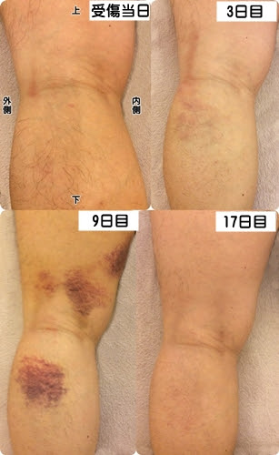 肉離れの治療 京都市 中京区右京区下京区 西院かんな整骨院