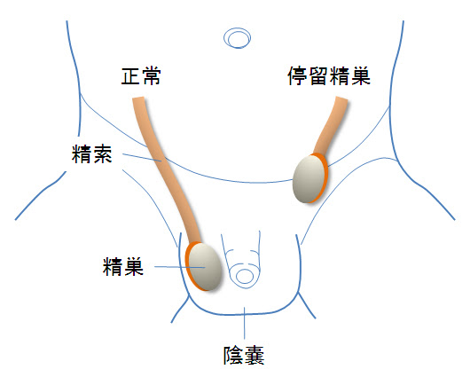 停留精巣 停留睾丸 すこやかコラム ときわ会グループ