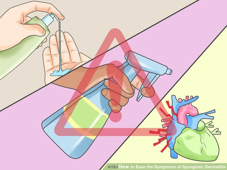 Ease the Symptoms of Spongiotic Dermatitis Step 3 Version 2.jpg