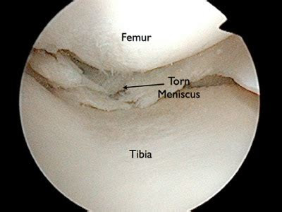If you're getting ready to have lung surgery or know someone who is, understanding what the different procedures involve. Sports and ACL Injuries: Meniscus Repair 2